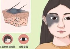 激光去胎记一次能做干净吗？胎记激光能彻底去除吗?