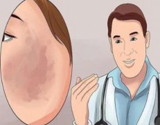 激光淡疤大概多少钱？激光淡疤痕作用怎么样?