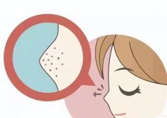 调q激光祛斑会反弹吗？做好护理和防晒一般不会反弹