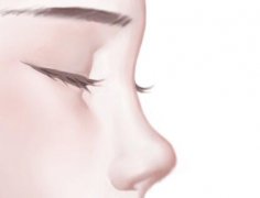 假体隆鼻恢复期大概多久？假体隆鼻的原理是什么