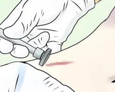 激光祛疤能彻底去掉吗？揭晓祛疤手术详情，含相关科普
