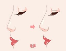 隆鼻二次修复难度高吗？二次隆鼻该选什么材料