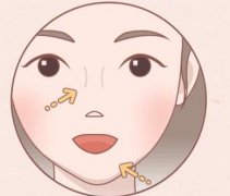 玻尿酸丰下巴可以维持多久？玻尿酸丰下巴需要多少支